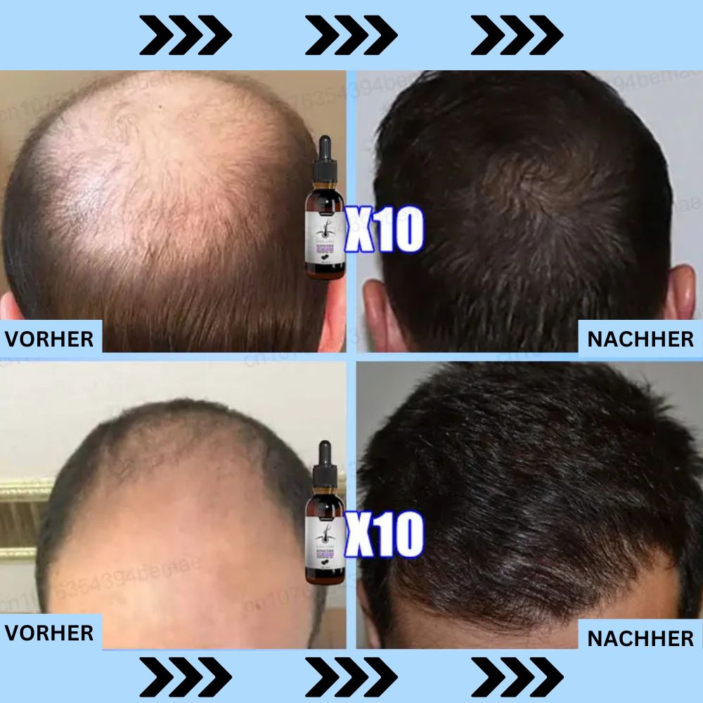 Sérum de croissance des cheveux ADENOSIN | Traitement rapide de la chute des cheveux dans les alopécies héréditaires et séborrhéiques 